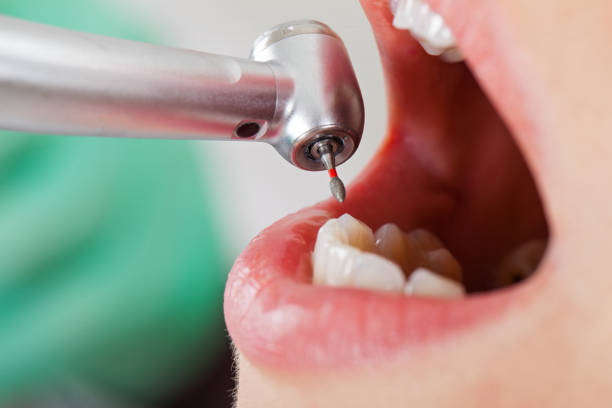 Best Emergency Tooth Extraction in Schulenburg, TX